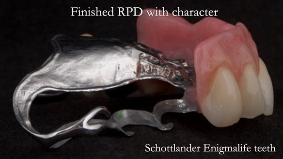 Eileen's transformation with upper and lower RPDs of Scandinavian hygienic design FULL PROTOCOL