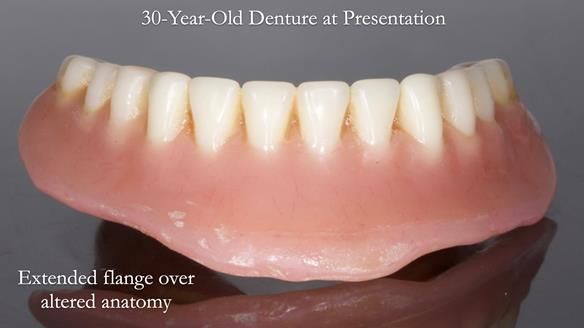 Newsletter 68 Restoring Jan’s Smile: Complete Dentures Inspired by Her Daughter’s Teeth - Post Mouth Surgery