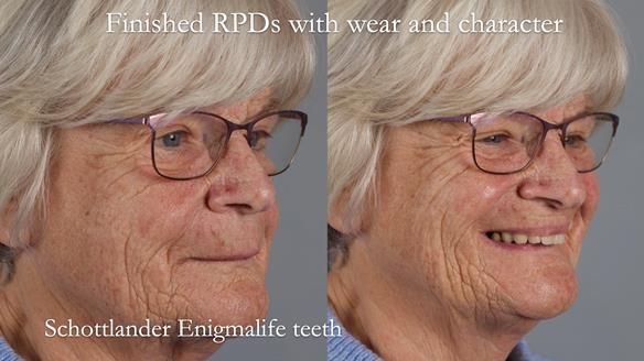 Eileen's transformation with upper and lower RPDs of Scandinavian hygienic design FULL PROTOCOL