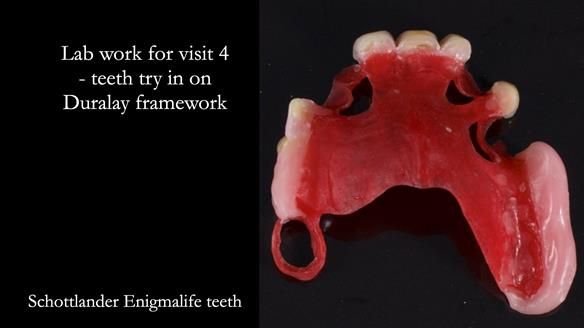 Managing Edgar “THE SCEPTIC” with an RPD/Splint FULL CASE