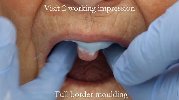 Newsletter 49 Managing Estelle’s failing implants with dentures FULL PROTOCOL