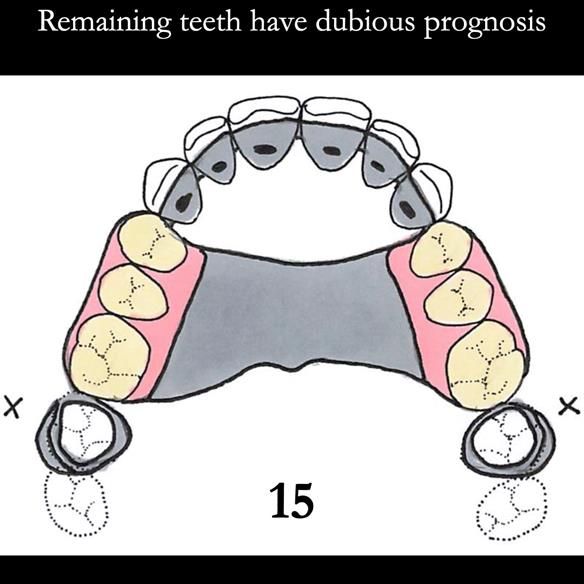 Universal Scandinavian partial denture designs