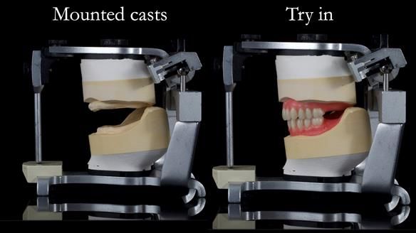 Newsletter 70 Complete Denture Treatment for Kate: A Case Study on Natural-Looking Dentures and Implant-Supported Overdentures