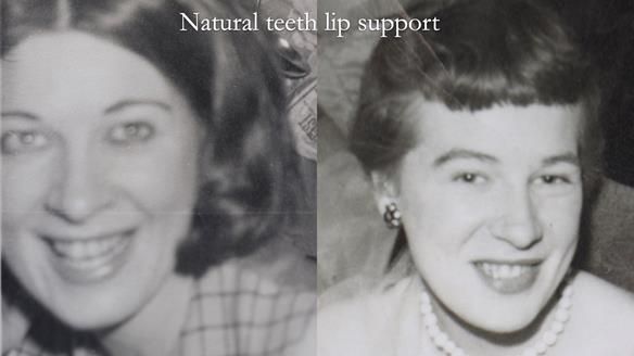 Newsletter 65 Marisa Provision of Complete Dentures on badly placed implants