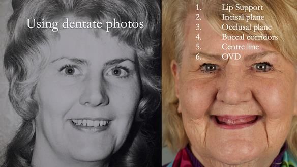 Replacing Madeline’s Complete denture FULL PROTOCOL