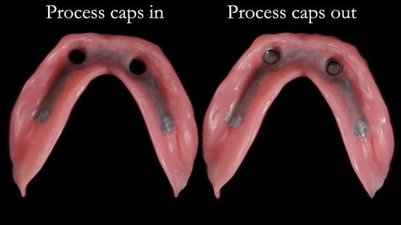 Newsletter 65 Marisa Provision of Complete Dentures on badly placed implants