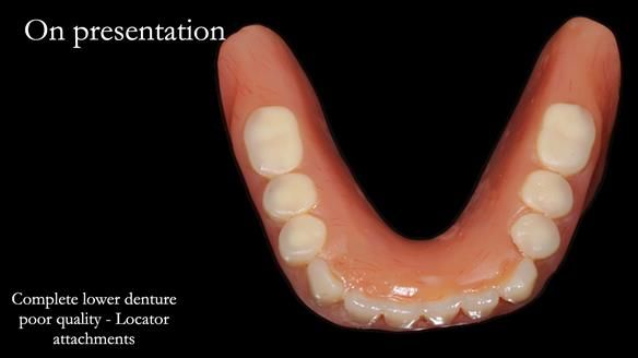 Newsletter 65 Marisa Provision of Complete Dentures on badly placed implants