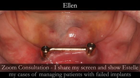 Newsletter 49 Managing Estelle’s failing implants with dentures FULL PROTOCOL