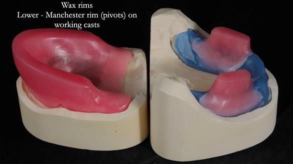 Newsletter 65 Marisa Provision of Complete Dentures on badly placed implants