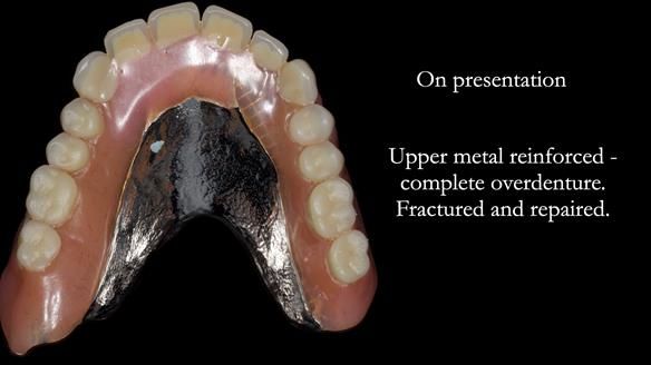 Newsletter 74: Ken’s Case Study Complete Dentures - Life Like and Age Appropriate