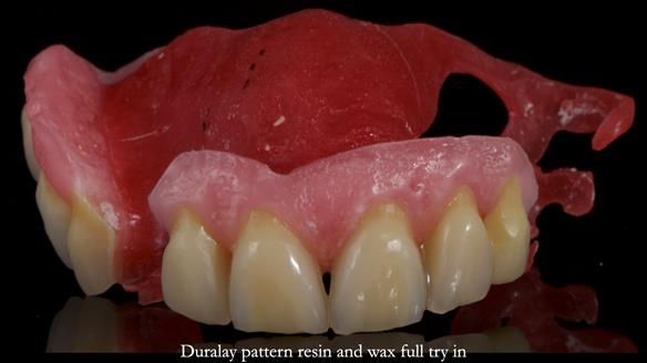 How Keith’s combat denture transformed his life – Newsletter 73