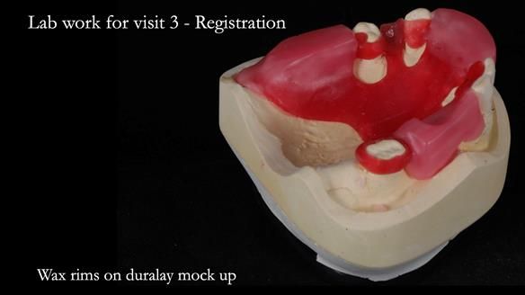 Managing Edgar “THE SCEPTIC” with an RPD/Splint FULL CASE