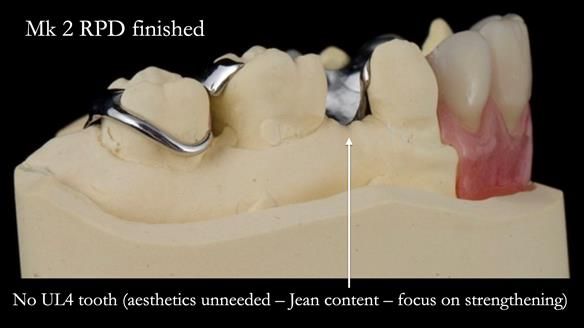 Newsletter 71 Jean’s Class I Mod III RPD: See my mistakes Fractured Mk1 to a Stronger Mk2 RPD (4 years on)