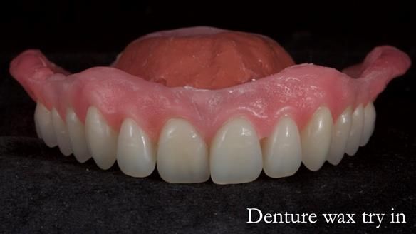 Newsletter 70 Complete Denture Treatment for Kate: A Case Study on Natural-Looking Dentures and Implant-Supported Overdentures