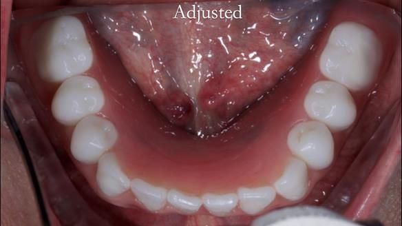 Newsletter 65 Marisa Provision of Complete Dentures on badly placed implants