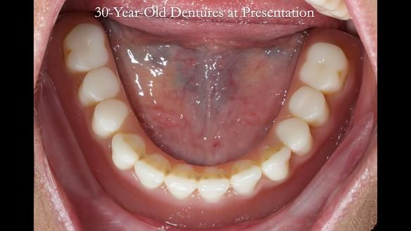 Newsletter 68 Restoring Jan’s Smile: Complete Dentures Inspired by Her Daughter’s Teeth - Post Mouth Surgery