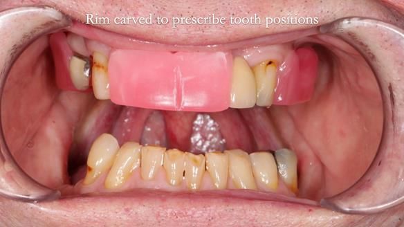 Managing Edgar “THE SCEPTIC” with an RPD/Splint FULL CASE