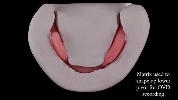 Replacing Madeline’s Complete denture FULL PROTOCOL