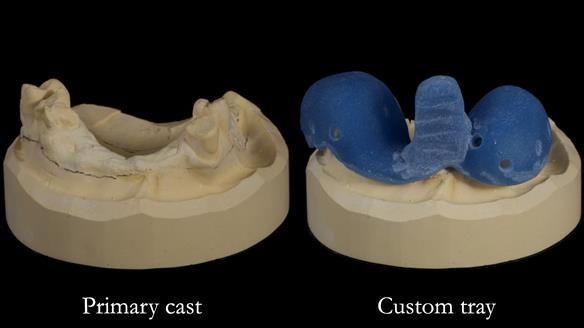 How Keith’s combat denture transformed his life – Newsletter 73