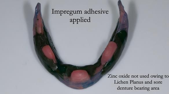 Replacing Madeline’s Complete denture FULL PROTOCOL