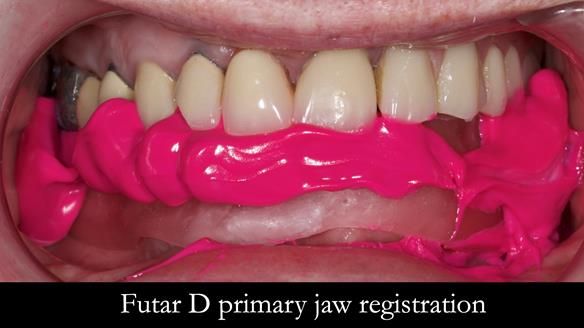 Newsletter 44 - extreme removable prosthodontics – engineering a super-strong and ultra-thin over denture