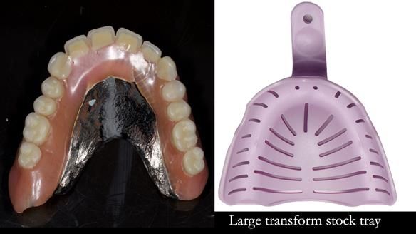 Newsletter 74: Ken’s Case Study Complete Dentures - Life Like and Age Appropriate