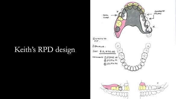 How Keith’s combat denture transformed his life – Newsletter 73