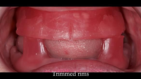 Replacing Madeline’s Complete denture FULL PROTOCOL