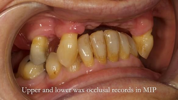 Newsletter 71 Jean’s Class I Mod III RPD: See my mistakes Fractured Mk1 to a Stronger Mk2 RPD (4 years on)