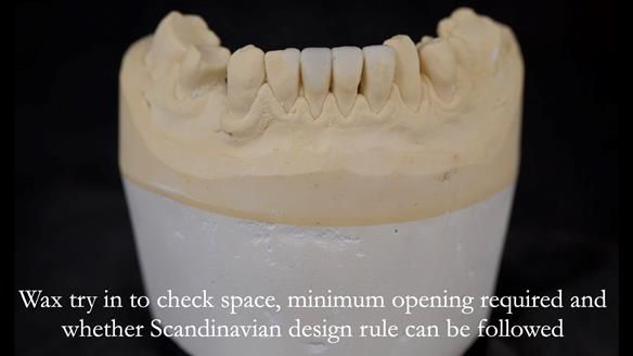 Read Newsletter 67 - Brian's COMBAT DENTURE Case Study