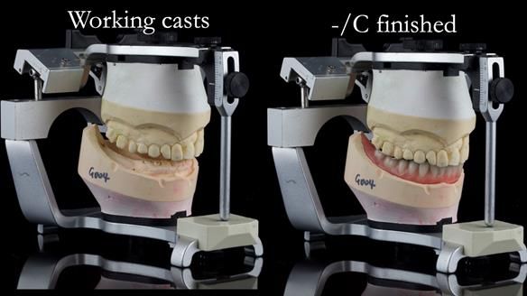 Newsletter 44 - extreme removable prosthodontics – engineering a super-strong and ultra-thin over denture