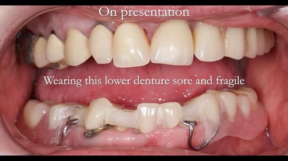 Newsletter 44 - extreme removable prosthodontics – engineering a super-strong and ultra-thin over denture