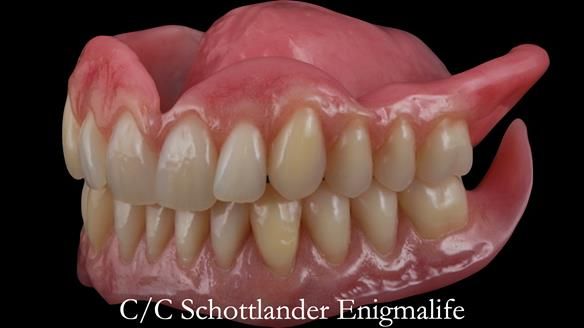 Newsletter 48 Mavis's Complete denture FULL PROTOCOL