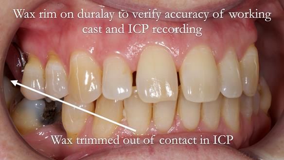 Solving Sue's failed implants with metal based RPD - full protocol Newsletter 43