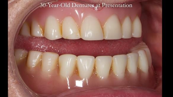 Newsletter 68 Restoring Jan’s Smile: Complete Dentures Inspired by Her Daughter’s Teeth - Post Mouth Surgery