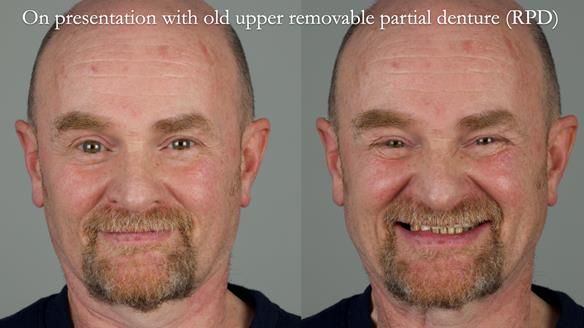 How Keith’s combat denture transformed his life – Newsletter 73