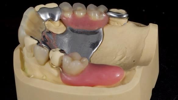 Managing Edgar “THE SCEPTIC” with an RPD/Splint FULL CASE