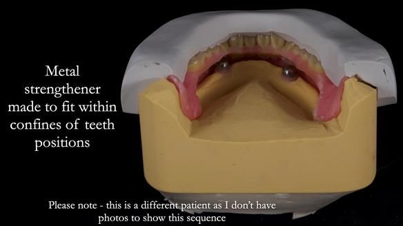 Newsletter 65 Marisa Provision of Complete Dentures on badly placed implants