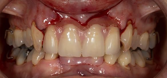  Figure 42 immediate denture fitted with patient in intercuspal position