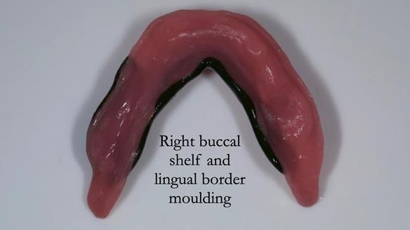 Newsletter 44 - extreme removable prosthodontics – engineering a super-strong and ultra-thin over denture