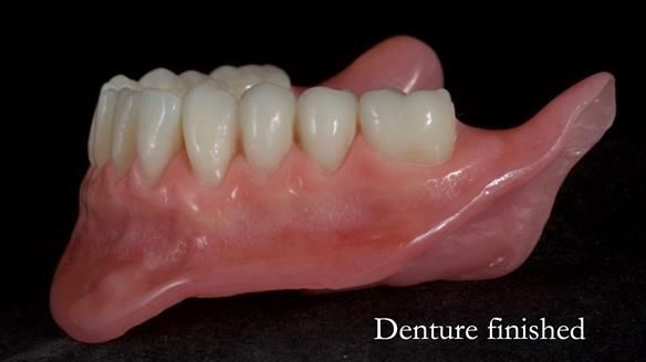 Newsletter 68 Restoring Jan’s Smile: Complete Dentures Inspired by Her Daughter’s Teeth - Post Mouth Surgery