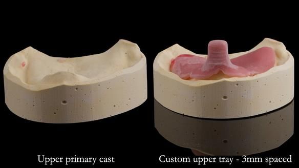 Replacing Madeline’s Complete denture FULL PROTOCOL