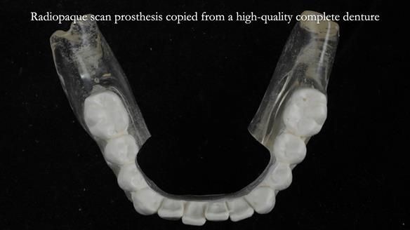 Newsletter 70 Complete Denture Treatment for Kate: A Case Study on Natural-Looking Dentures and Implant-Supported Overdentures