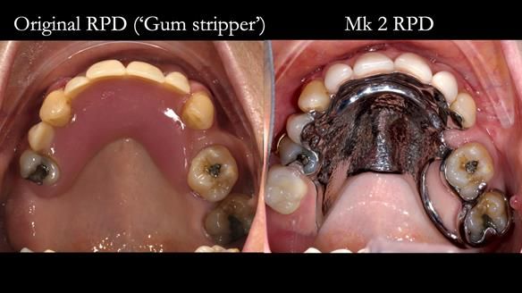 Newsletter 71 Jean’s Class I Mod III RPD: See my mistakes Fractured Mk1 to a Stronger Mk2 RPD (4 years on)