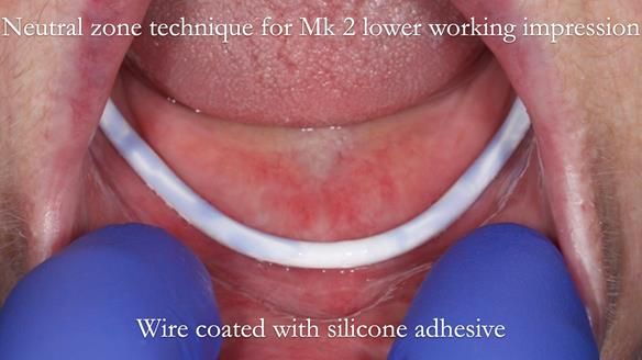 Replacing Madeline’s Complete denture FULL PROTOCOL