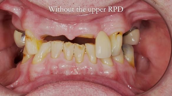 Managing Edgar “THE SCEPTIC” with an RPD/Splint FULL CASE