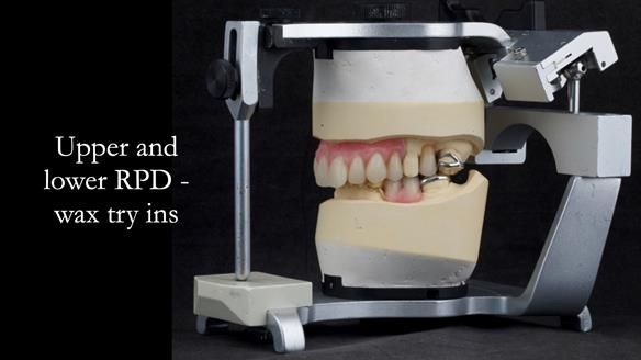 Eileen's transformation with upper and lower RPDs of Scandinavian hygienic design FULL PROTOCOL