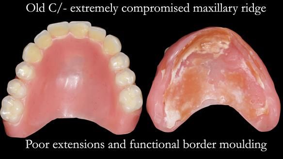 Replacing Madeline’s Complete denture FULL PROTOCOL