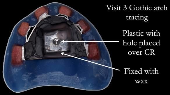 Newsletter 70 Complete Denture Treatment for Kate: A Case Study on Natural-Looking Dentures and Implant-Supported Overdentures