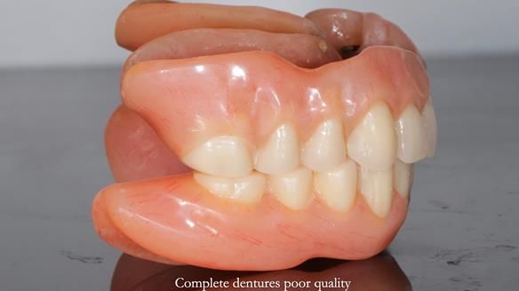 Newsletter 65 Marisa Provision of Complete Dentures on badly placed implants